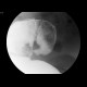Blind stenosis of sigmoid colon, ileus: RF - Fluoroscopy